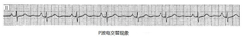 P波电交替