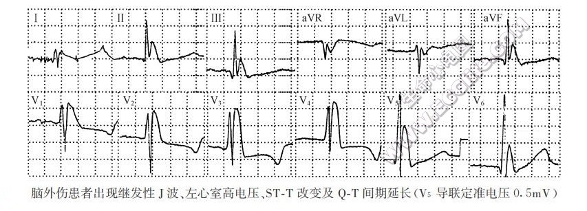 脑外伤患者出现继发性J波(心电图)