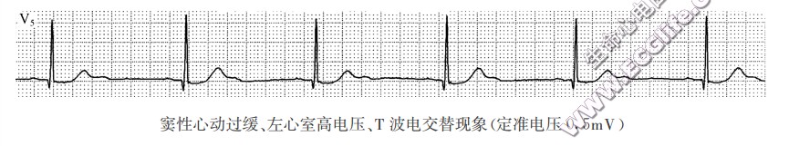 窦性心动过缓、左心室高电压、T波电交替现象（心电图）