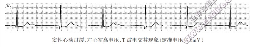 T波电交替现象