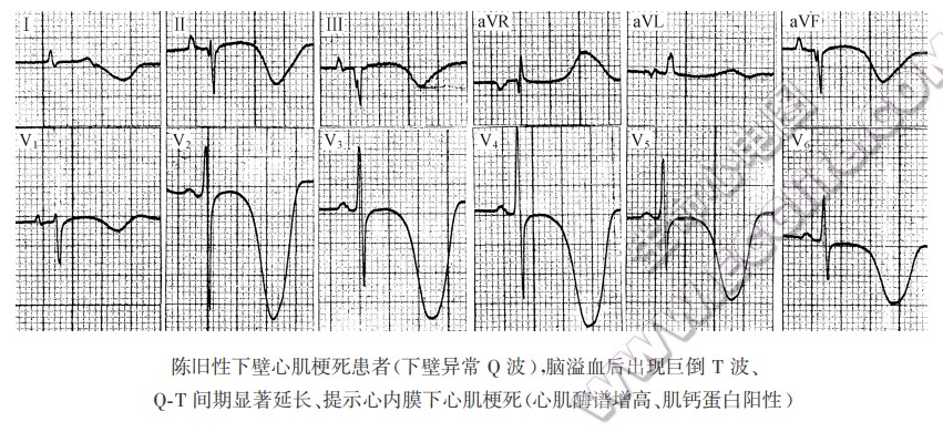 心内膜下梗死性巨倒T波（心电图）