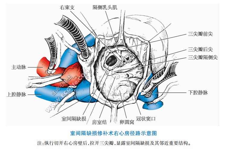 室间隔缺损修补术右心房径路示意图