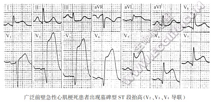 st段抬高心电图怎么看图片