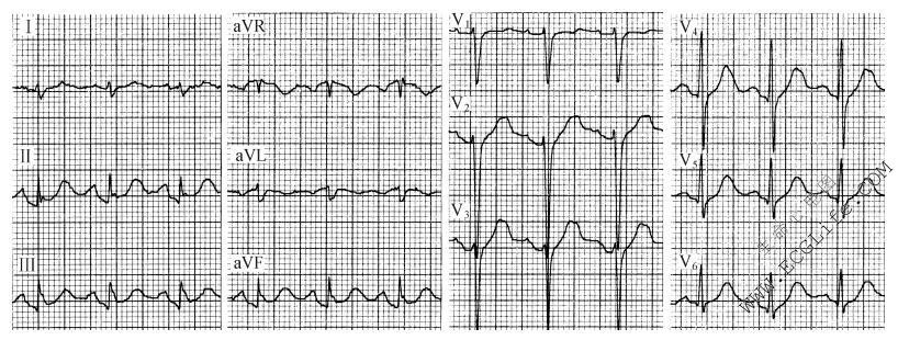急性心包炎患者出现窦性心动过速、肢体导联QRS波群低电压倾向、PR段压低（心电图）