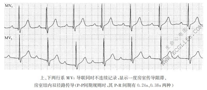 房室结内双径路传导（心电图）