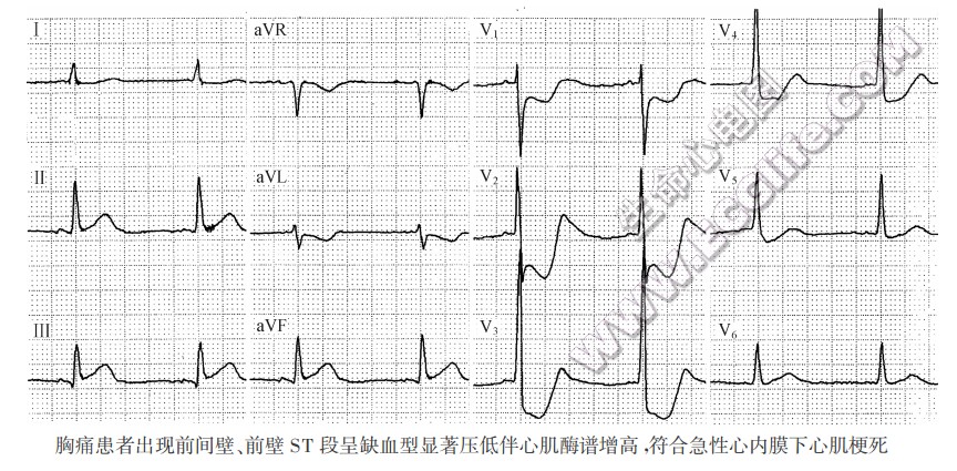 胸痛患者出现前间壁、前壁ST段呈缺血型显著压低伴心肌酶谱增高，符合急性心内膜下心肌梗死（心电图）