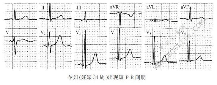 PR间期异常改变