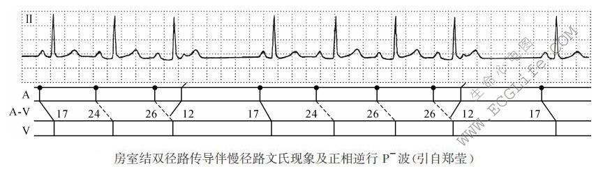 qrs波群后可见逆行p波图片