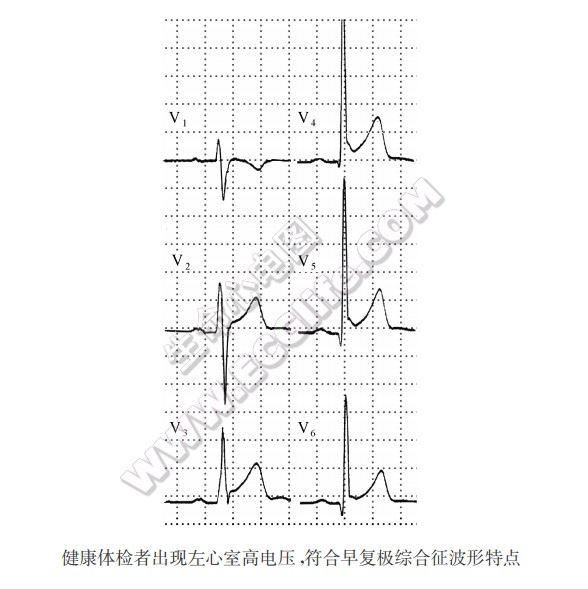 早复极综合征（心电图）