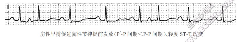 房性早搏促进窦性节律提前发放（心电图）