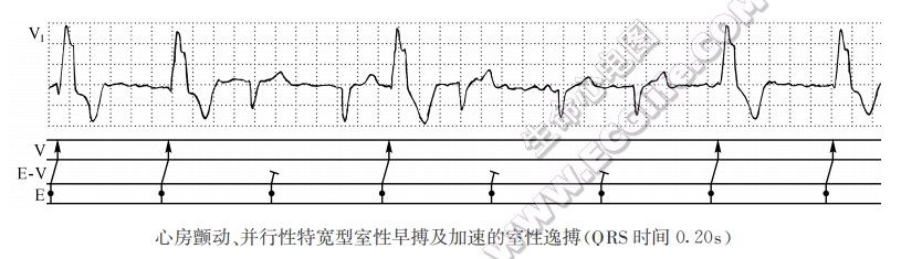 心房颤动、并行性特宽型室性早搏及加速的室性逸搏(QRS时间0.20s)（心电图）