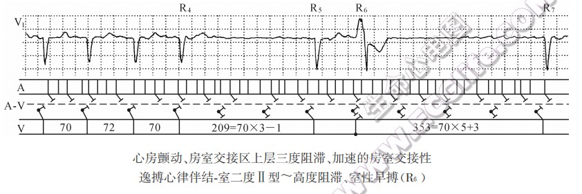 心房颤动、房室交接区上层三度阻滞、加速的房室交接性逸搏心律伴结．室二度Ⅱ型～高度阻滞、室性早搏(R6)（心电图）