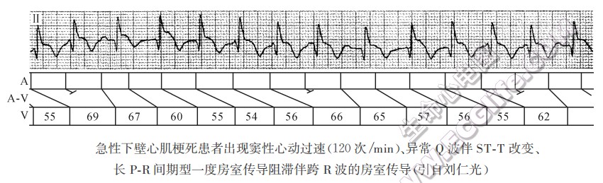 急性下壁心肌梗死患者小现窦性心动过速、异常O波伴ST-T改变、长P-R间期型一度房室传导阻滞伴跨R波的房室传导（心电图）