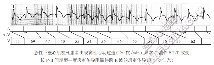 房室传导阻滞的诊断热点