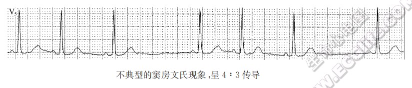 各个传导组织的文氏现象