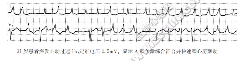 31岁患者突发心动过速1h，定准电压0.5mV。显示A型预激综合征合并快速型心房颤动（心电图）