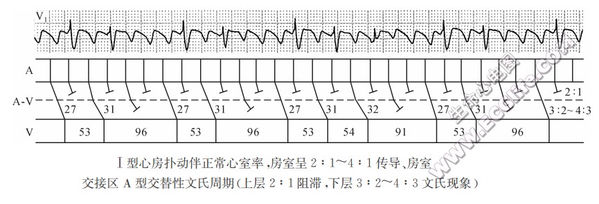心房扑动伴房室交接区A型交替性文氏周期（心电图）