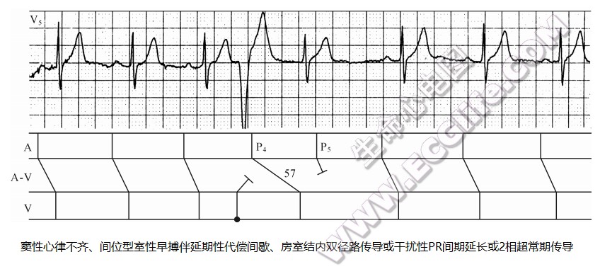 窦性心律不齐、间位型室性早搏伴延期性代偿间歇、房室结内双径路传导或干扰性P-R间期延长或2相超常期传导（心电图）