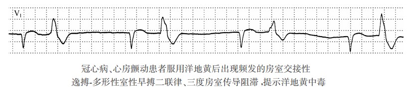 冠心病、心房颤动患者服用洋地黄后出现频发的房室交接性逸搏-多形性室性早搏二联律、三度房室传导阻滞，提示洋地黄中毒（心电图）