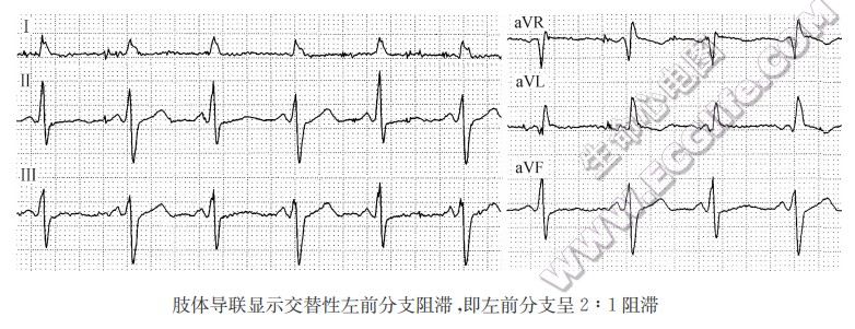 肢体导联显示交替性左前分支阻滞，即左前分支呈2：1阻滞（心电图）