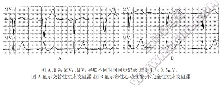 交替性左束支阻滞，窦性心动过缓、不完全性左柬支阻滞（心电图）