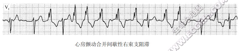 心房颤动合并间歇J陛右柬支阻滞（心电图）