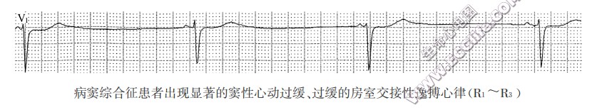 房室交接性逸搏和逸搏心律