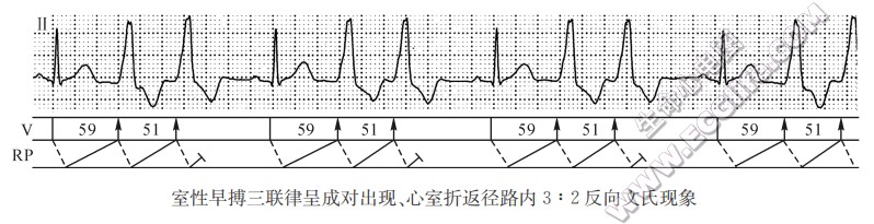 室性早搏三联律呈成对出现、心室折返径路内3:2反向文氏现象（心电图）