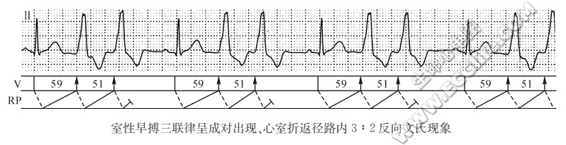 异-心室肌交接区传出阻滞