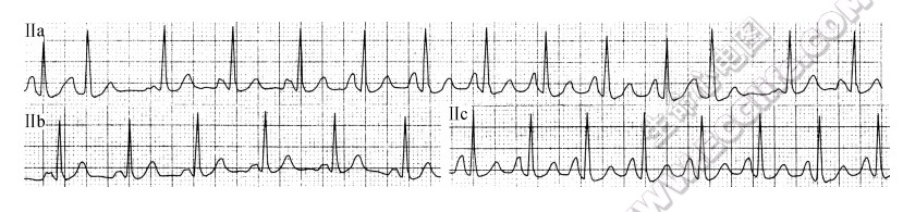 风心病、二尖瓣狭窄伴关闭不全患者（心电图）