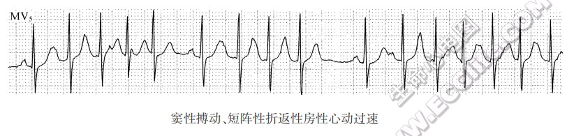 窦性搏动、短阵性折返性房性心动过速（心电图）