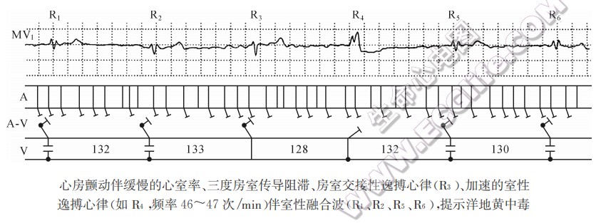 心房颤动伴缓慢的心室率、三度房室传导阻滞、房室交接性逸搏心律(R3)、加速的室性逸搏心律（心电图）