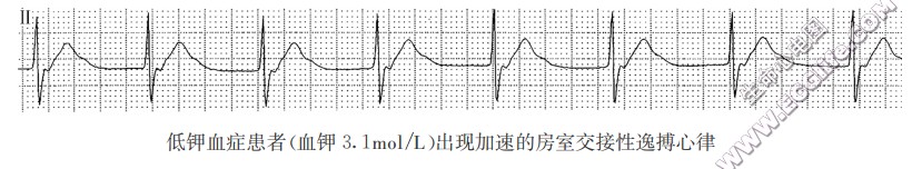 低钾血症患者（血钾3.1mol/L）出现加速的房室交接性逸搏心律（心电图）