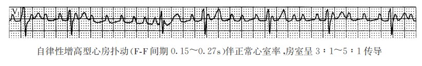 自律性增高型心房扑动（心电图）