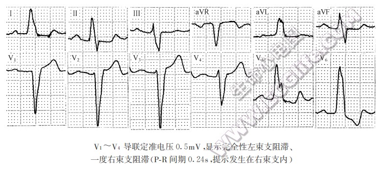 左束支阻滞的分类及心电图表现