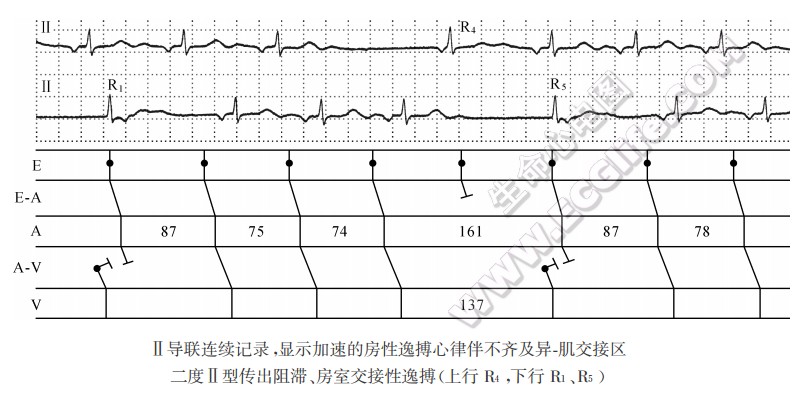 Ⅱ导联连续记录，显示加速的房性逸搏心律伴不齐及异-肌交接区二度Ⅱ型传H{阻滞、房室交接性逸搏