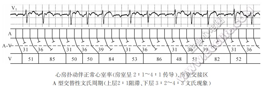 心房扑动伴正常心窒率（心电图）