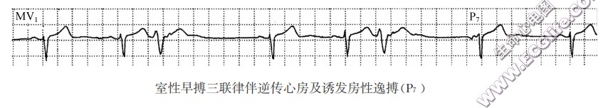 室性早搏三联律伴逆传心房及诱发房性逸搏(P7)（心电图）
