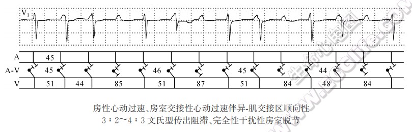 顺向性二度Ⅰ型异，肌交接区传出阻滞（心电图）