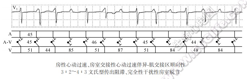 房室交接区异-肌传出阻滞