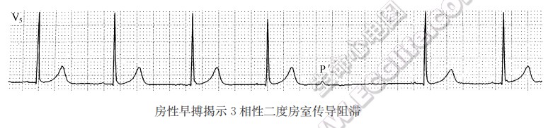 房性早搏揭示3相性二度房室传导阻滞