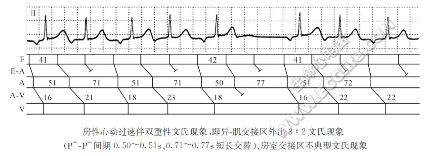 房性心动过速伴双重性文氏现象（心电图）