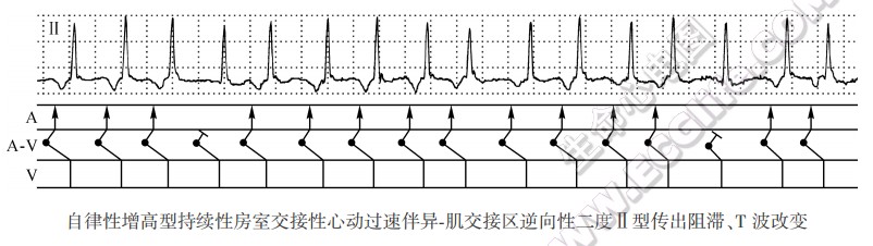 自律性增高型持续性房室交接性心动过速伴异-肌交接区逆向性二度Ⅱ型传小阻滞、T波改变（心电图）