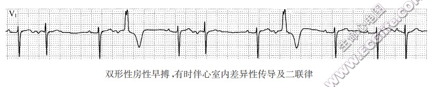 双形性房性早搏，有时伴心室内差异性传导及二联律（心电图）