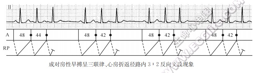 成对房性早搏呈三联律、心房折返径路内3:2反向文氏现象（心电图）