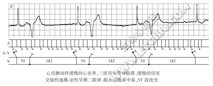 心房颤动伴缓慢的心室率、三度房室传导阻滞、缓慢的房室交接性逸搏．室性早搏二联律，提示洋地黄中毒、ST段改变（心电图）