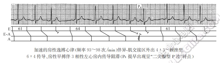 3相性心房内传导阻滞（心电图）