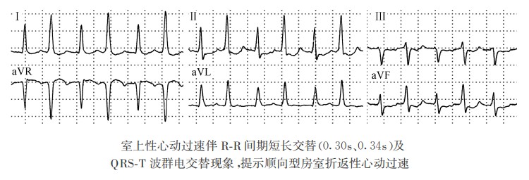 房室折返性心律失常