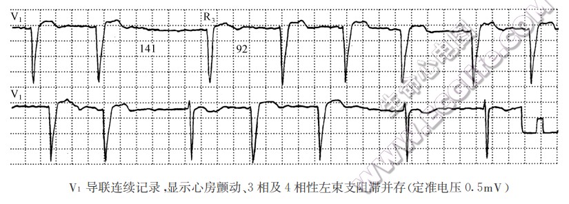 V1导联连续记录，显示心房颤动、3相及4相性左柬支阻滞并存(定准电压0.5mV)（心电图）