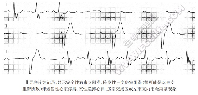 与频率无相关性阵发性三度房室传导阻滞